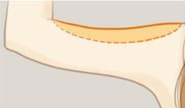 劉金超磨骨手術(shù)：專家點(diǎn)評(píng)+價(jià)格表解析，全面了解醫(yī)生技術(shù)及口碑