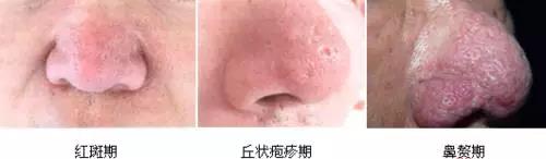 解密楊杰雙眼皮修復(fù)失敗案例圖，讓你心中的期望成為現(xiàn)實！