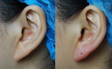 洛陽手術(shù)疤痕去除哪家好？選擇靠譜專業(yè)的洛陽疤痕修復(fù)中心