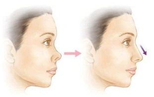 長沙美萊潘衛(wèi)峰做脂肪填充效果如何？醫(yī)生經(jīng)驗(yàn)口碑詳細(xì)了解！