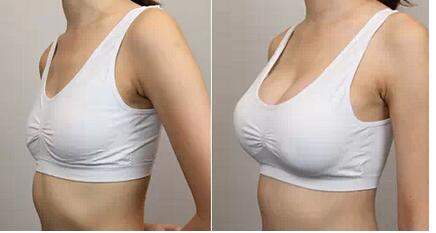 廣州脂肪隆胸醫(yī)生技術高超，手術效果自然倍受贊譽