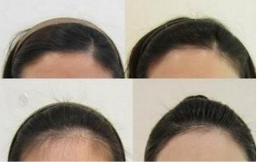 哈爾濱皮秒手術(shù)哪家醫(yī)院好？全面評測哈爾濱皮秒醫(yī)院排名