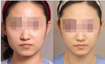 河南去胎記哪家醫(yī)院好？解析最適合您的整形醫(yī)院