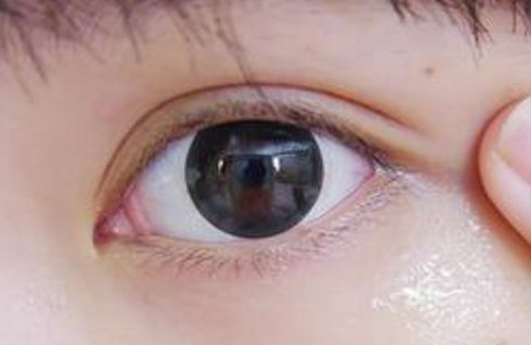 山東割眼袋哪家醫(yī)院好？眼袋手術(shù)山東醫(yī)院哪家專業(yè)靠譜？