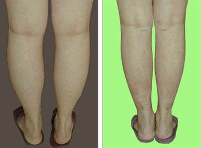 2023廈門懸吊除皺祛法令紋口碑前十名專家(王陽(yáng)明、董新、肖磊勇爭(zhēng)前列！)