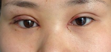 沈陽(yáng)哪家醫(yī)院疤痕手術(shù)效果好？