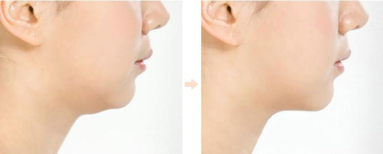 2023深圳面部填充面部皺紋專家前十名排行(曹琛、符國興、雋洪艷這些醫(yī)生權(quán)威有實力，值得信賴)