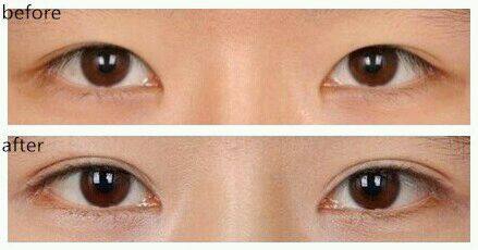 2023蘭州假體隆胸手術(shù)權(quán)威醫(yī)生上榜前10位(任延俠、李金成、張志慶實力口碑廣受好評)