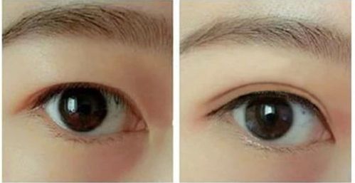 揭秘！哈爾濱哪家醫(yī)院的隆鼻手術(shù)效果最好推薦