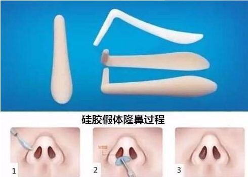 北京哪家醫(yī)院祛除眼袋效果最好？