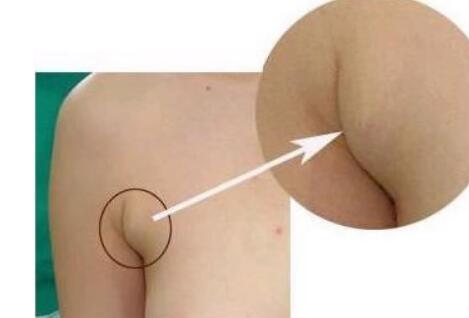 張誠教授為您的雙眼皮修復(fù)提供完美解決方案！成功案例分享，糾正雙眼皮失敗的救星~