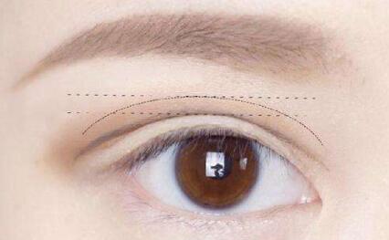 上海隆胸醫(yī)生推薦！何晉龍醫(yī)生術(shù)后效果挺拔圓潤(rùn)！