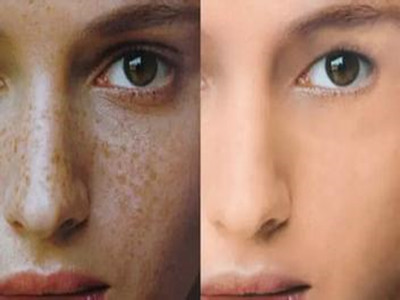 2023長沙妊娠紋干細胞填充口碑排行前十名專家(張小蕓、羅成群、劉海實力前三無人能及！)