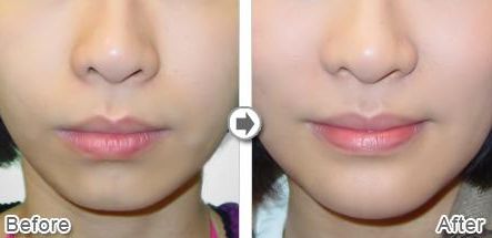 武漢熱瑪吉技術(shù)治療最好的醫(yī)院是哪家？