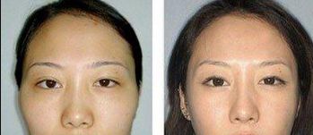 重慶去眼袋哪家醫(yī)院好？選擇靠譜的醫(yī)療機(jī)構(gòu)，功效更可靠！