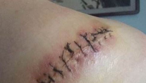 信陽哪家醫(yī)院祛痘效果好，專家推薦去哪家醫(yī)院治療痘痘？