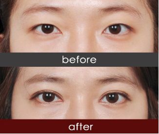 南京哪家專業(yè)醫(yī)院可以做雙眼皮手術？