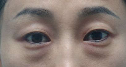 天津醫(yī)院去疤膏效果好的有哪些？