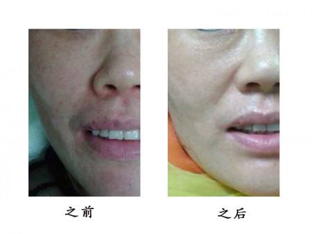 2023南通激光去除靜態(tài)紋權(quán)威專家排行榜前十名(朱興華、徐保安、徐保安各個實力不凡)