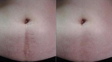 【大連市激光袪疤治療排名】哪家醫(yī)院激光袪疤好？