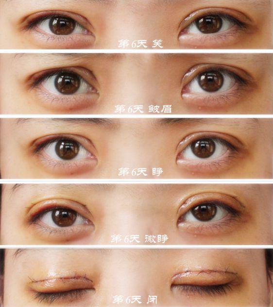 武漢哪家醫(yī)院做眼袋手術(shù)好又專業(yè)有效