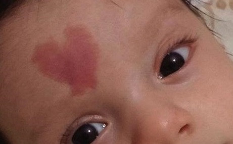 肖開宇修復雙眼皮的方法淺析，成都知名整形醫(yī)生成功案例分享！