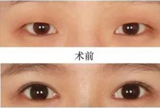 昆明哪家醫(yī)院做熱瑪吉好？挑選昆明熱瑪吉治療專業(yè)的醫(yī)院指南