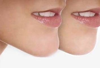 河南唇腭裂休復(fù)哪家好？專業(yè)醫(yī)院推薦及成功案例分享