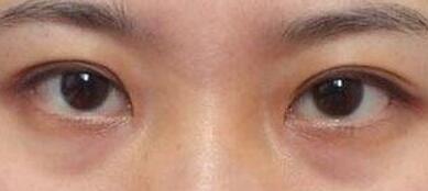 何照華下頜角手術(shù)的效果如何？明星們做了手術(shù)前后對比驚艷！