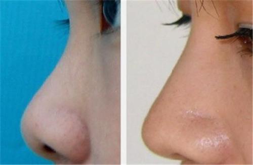 2023哈爾濱做硅膠窿鼻正規(guī)專家推薦TOP10強(王新東、袁國慶、劉思佳醫(yī)生大咖技術過硬)