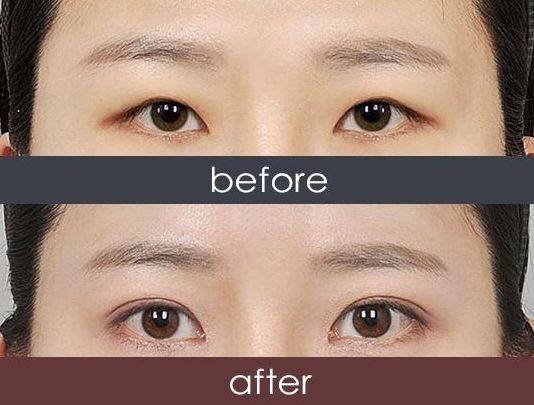 福州哪家醫(yī)院激光祛雀斑效果好？