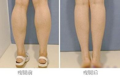 全國(guó)激光點(diǎn)痣哪家醫(yī)院好？帶你全面了解最佳選擇！