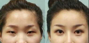 深圳隆鼻手術(shù)效果如何？哪家醫(yī)院的鼻綜合技術(shù)較好？