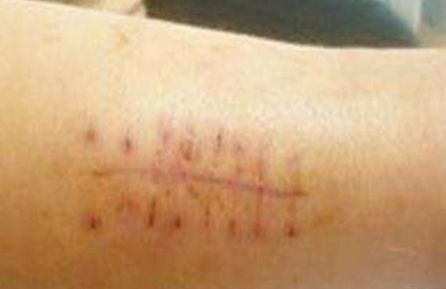 重慶治療雀斑靠譜的醫(yī)院有哪些？