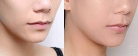 沈陽朱石江顴骨整形手術(shù)具有良好效果？詳解醫(yī)生推薦報道！