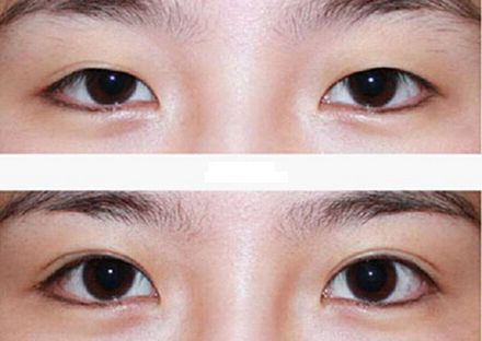 【2023年蘭州歪脖子手術(shù)哪家好？專家推薦+真實(shí)案例分析】