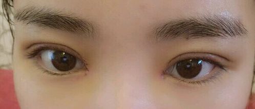 福州哪里可以去除胎記？福州去胎記醫(yī)院排名哪家好？