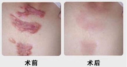 昆明有沒(méi)有哪家專業(yè)祛痘醫(yī)院值得推薦？