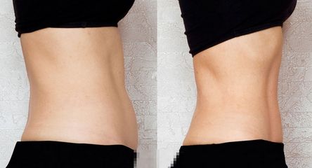 朝陽市哪家醫(yī)院做雙眼皮效果好？