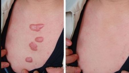 山西太原雙眼皮哪家好？為您推薦最受歡迎的太原雙眼皮醫(yī)療中心！