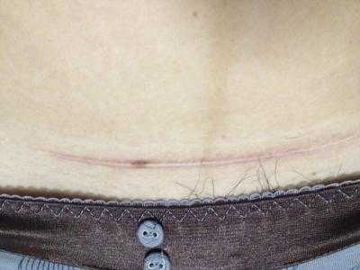 2023內(nèi)蒙古吸脂瘦身腹權(quán)威專家上榜前幾(李曉梅、劉露、韓楓技術(shù)、審美、口碑通通有)