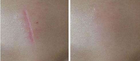 深圳哪家醫(yī)院脂肪豐胸效果好？