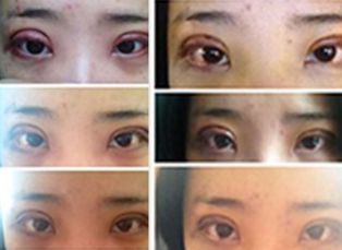 長沙哪家醫(yī)院的拉皮手術(shù)最好？專家推薦的拉皮手術(shù)醫(yī)院有哪些？