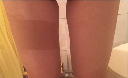 山東哪家醫(yī)院治療疤痕好？挑選最適合您的醫(yī)療機(jī)構(gòu)！