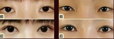 嘟嘟唇無錫哪家醫(yī)院好？專家推薦無錫哪家醫(yī)院治療嘟嘟唇好