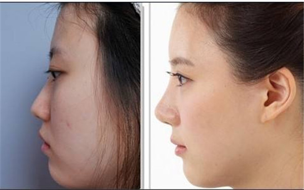 尹寧北唇裂的治療方法與修復手術(shù)現(xiàn)場展示！擁有自信笑容的秘訣！