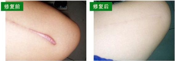 上海微創(chuàng)除皺哪家醫(yī)院好？了解上海微創(chuàng)除皺治療的專業(yè)醫(yī)院推薦