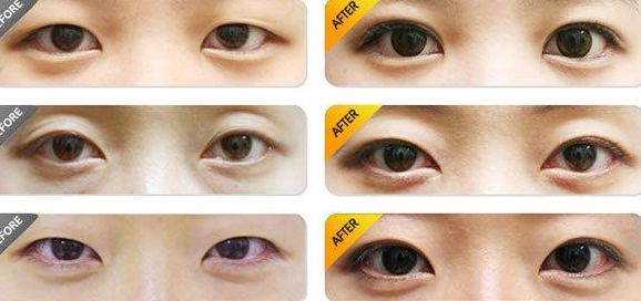 北京做雙眼皮哪家醫(yī)院好？排名最靠前的北京雙眼皮醫(yī)院有哪些？