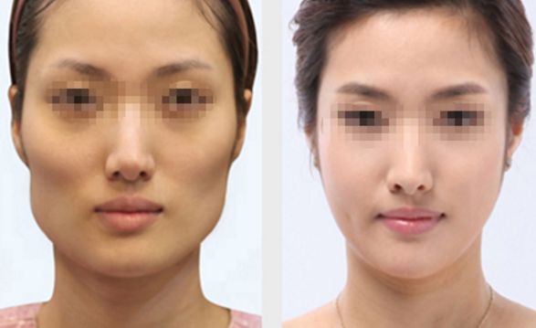 長春雙眼皮修復(fù)好的醫(yī)院有哪些？