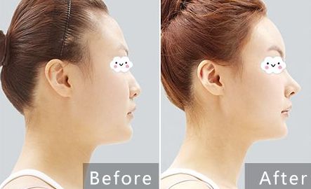 貴陽治療痘坑哪家醫(yī)院專業(yè)可靠？